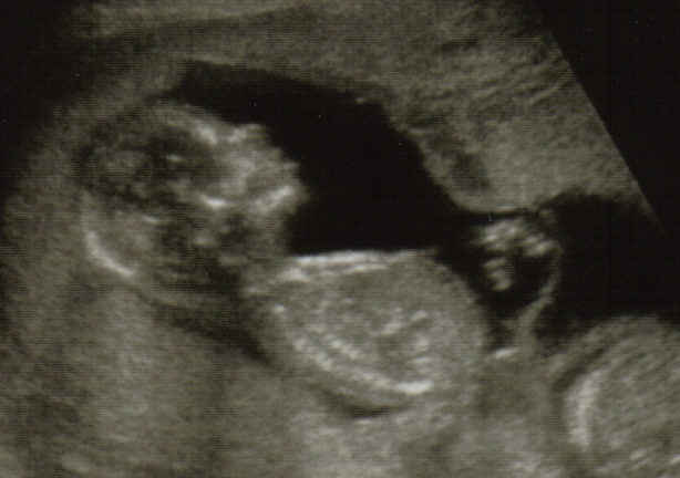 Плод в 13 14 недель беременности фото